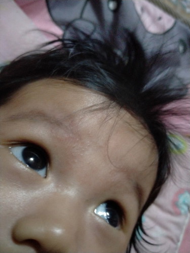ผดผื่นที่หน้า