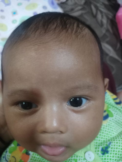 Wajah bayi bercak putih seperti panu