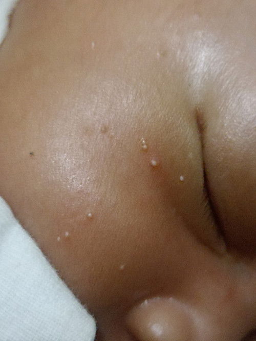 Bintik putih pada bayi