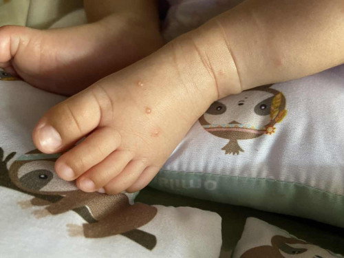 Bintil pada kaki bayi