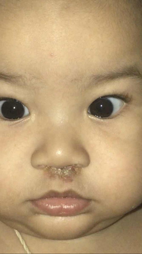 ขอคำปรึกษาจากเเม่ๆหน่อยค่ะ
ลูกเป็น7วันเเล้ว เอาเเต่ทายา