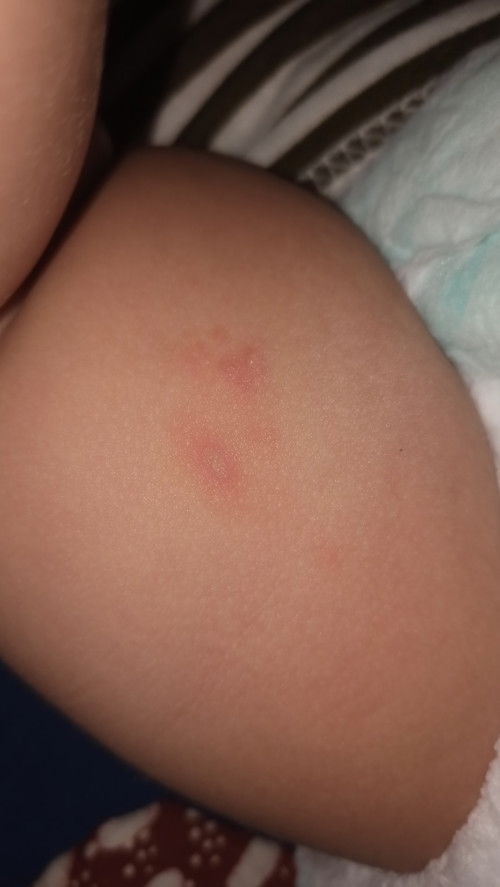 Bintik merah seperti mau bernahah di Paha si kecil