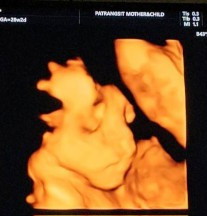 น้ำหนักต่ำกว่าเกณฑ์