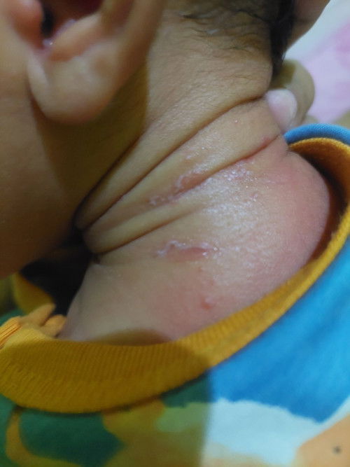 Sharing bun,siapa yg anknya pernah kyk gni? Dkasi apa ya,supaya cpt hilang?