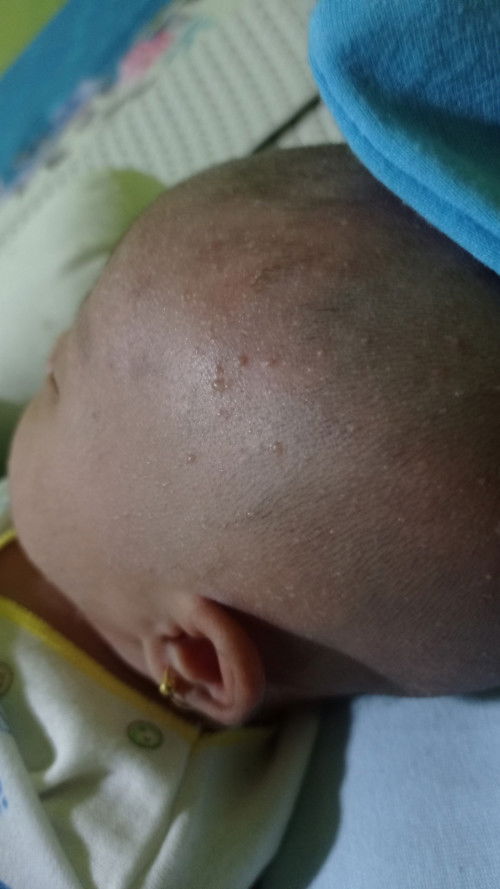 Cara atasi bintik berair