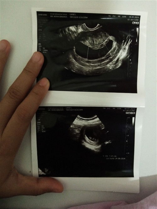 Janin Tidak Berkembang