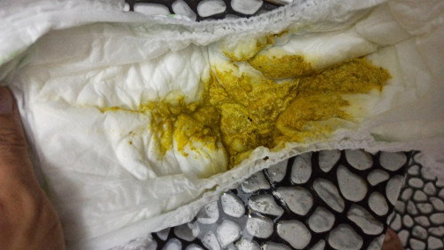 Buang air besar kerap dan tekstur ada macam lendir