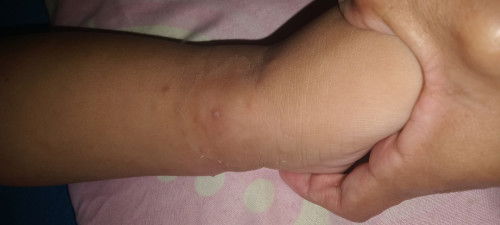 Keluar bintik di kaki tp timbul  dan tidak memerah di kaki anak dan di area bintik itu mengeras