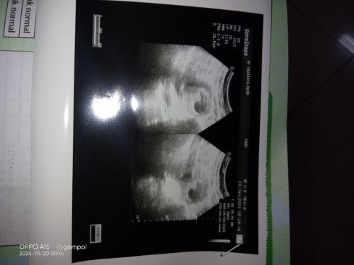 Usg tp masih belum ada janin ukuran 8minggu