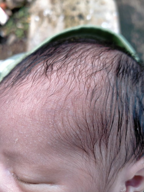 Beruntusan di kepala bayi