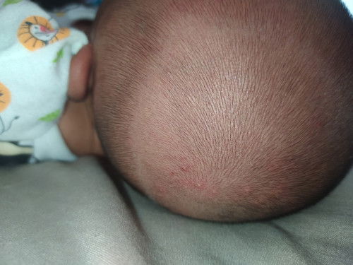 Beruntusan di kepala, aman ngga?