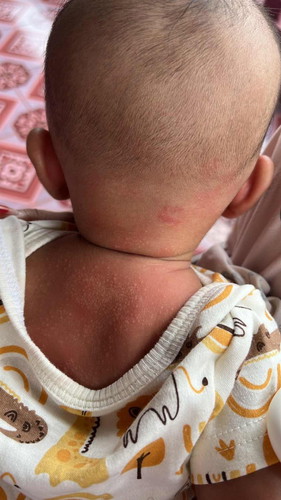 RUAM BABY 3 BULAN MERAH TAK HILANG MAKIN BESAR