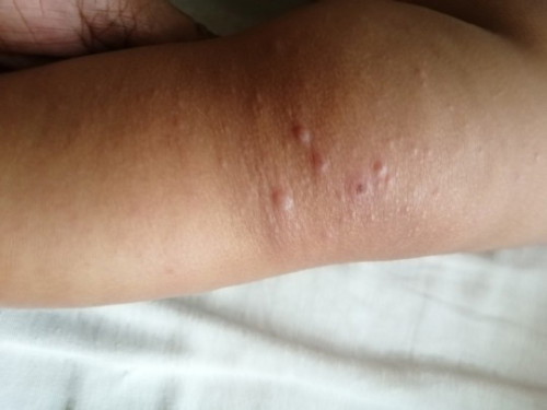 Hi mga momshies, bulutong po kaya tong tumutubo sa katawan ni baby or rashes?