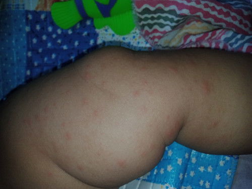 Bentol merah pada bayi