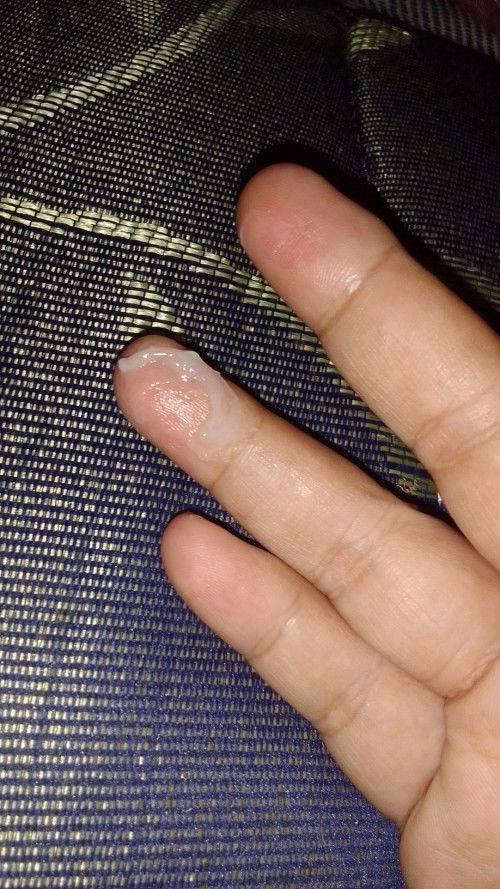 Keputihan berbentuk jelly di UK 17week