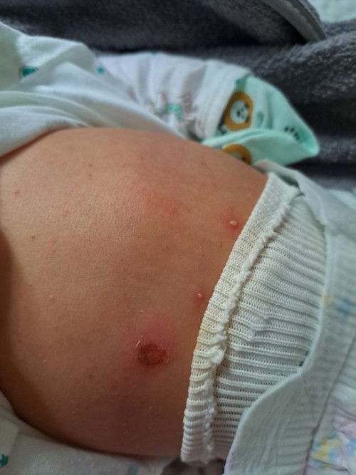 Bé sơ sinh bị nốt trên người