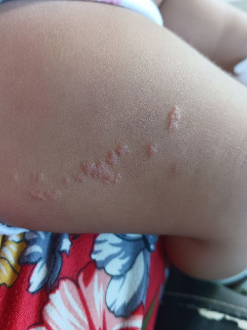 pneumococcal conjugate vaccine