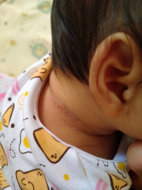 คอลูกถลอกแบบนี้ทำยังไง