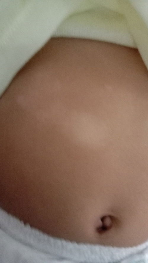 Bintik²putih di kulit bayi