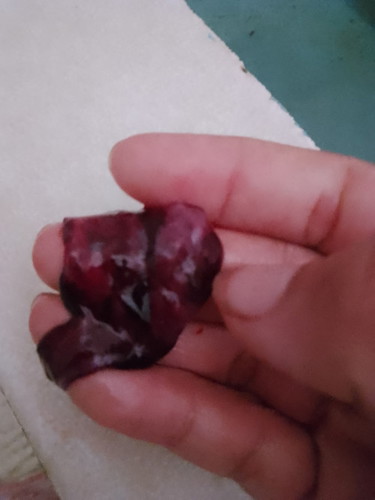 Bun apakah ini janin yang gugur soalnya keluar gumpalan dan bercak darah tapi masih ada kantungnya
