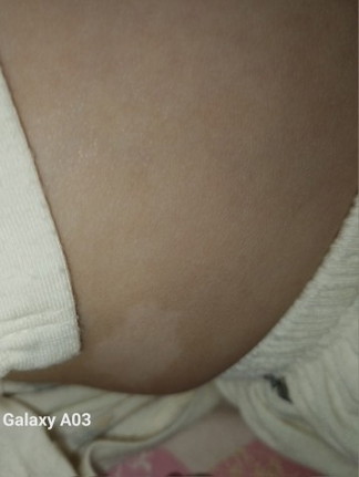 Các mom cho em hỏi bé nhà em có vết này có phải là bị lang ben ko ạ?.Và bôi gì cho nó hết v ạ?