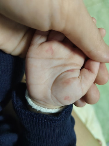 มือนน้องแดงจ้ำๆ