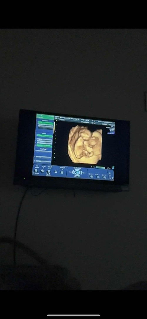 14w5d หมอนัดดูเพศ