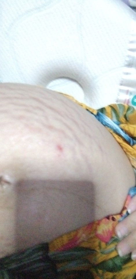 35 weeks pregnant, napako