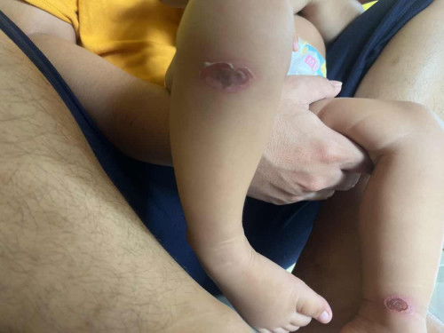 Luka berair pada bayi 1 tahun