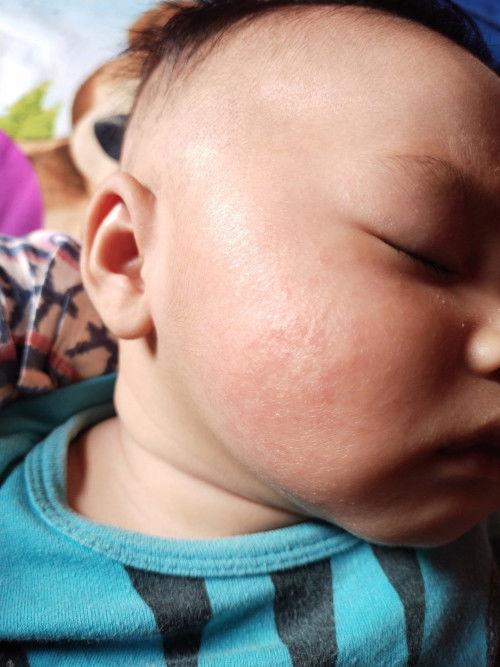 Obat paling ampuh untuk ruam merah dipipi bayi?