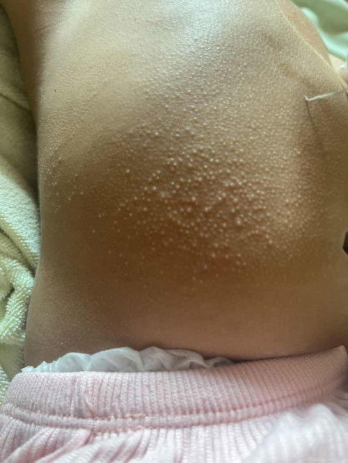 ผดแบบนี้คือผดอะไรคะแม่ๆ