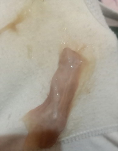 Keluar tanda seperti ini kira kira kenapa ya Bun
Bahaya atau tidak
Apa perlu periksa k dokter??
