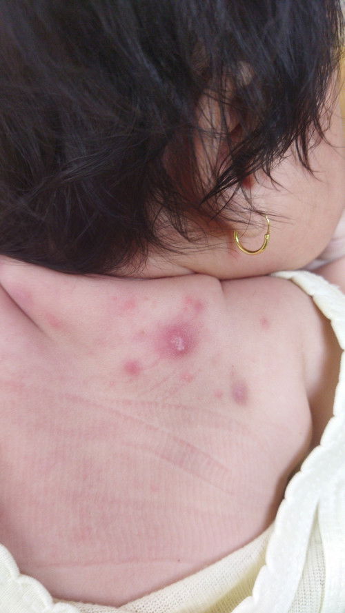 Bund info dong tips / obat untuk bayi 3 bulan bund, kulit bayi aku ada nanahnya dan pindah" gitu