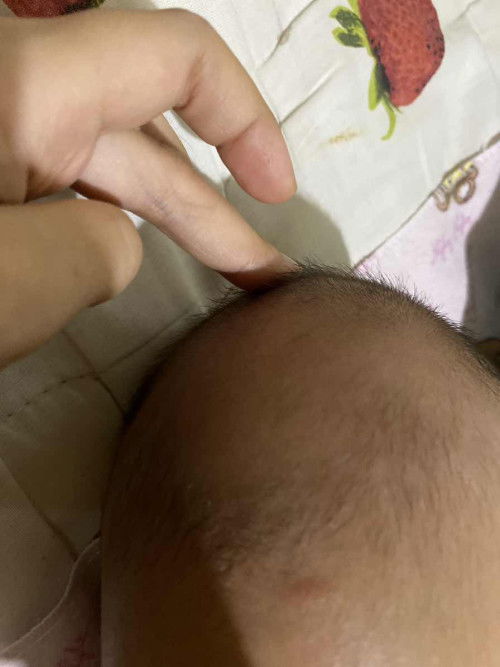 Garis di atas tengkorak kepala bayi