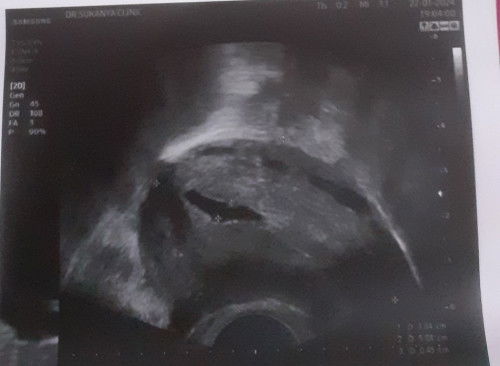 เเม่ช่วยดูหน่อยค่ะท้องคนที่2ค่ะหมอบอกเสี่ยงเเท้งกับท้องนอกมดลูกเเบบนี้เเม่ๆคิดว่ารอดมั้ยค่ะรึใครดูออ