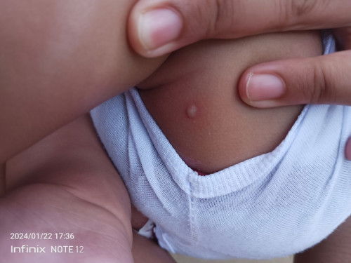 Mga mhi ano kaya ito biglang tumubo sa baby ko , at anong pwedeng igamot kaya dito