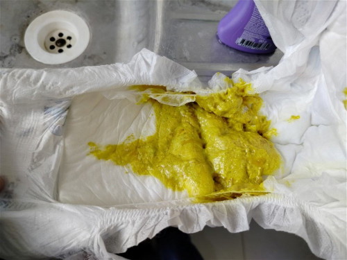 Kenapa baby 5 bulan berak tahi kuning bercampur lendir dan macam darah pon ada