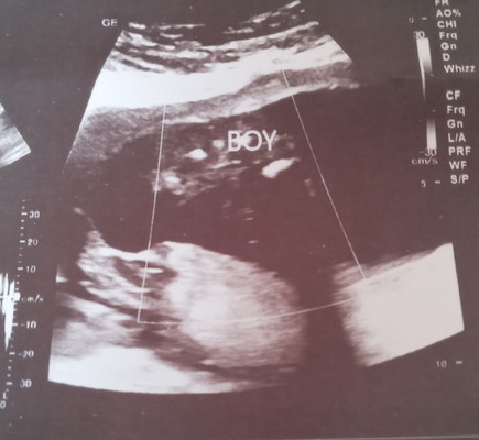 Posible ba magkamali ang ultrasound kung girl or boy ang baby ?