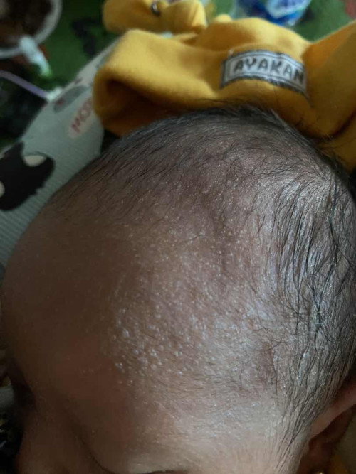 Bintik” pada newborn