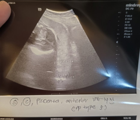 Pp type 3 - 33week