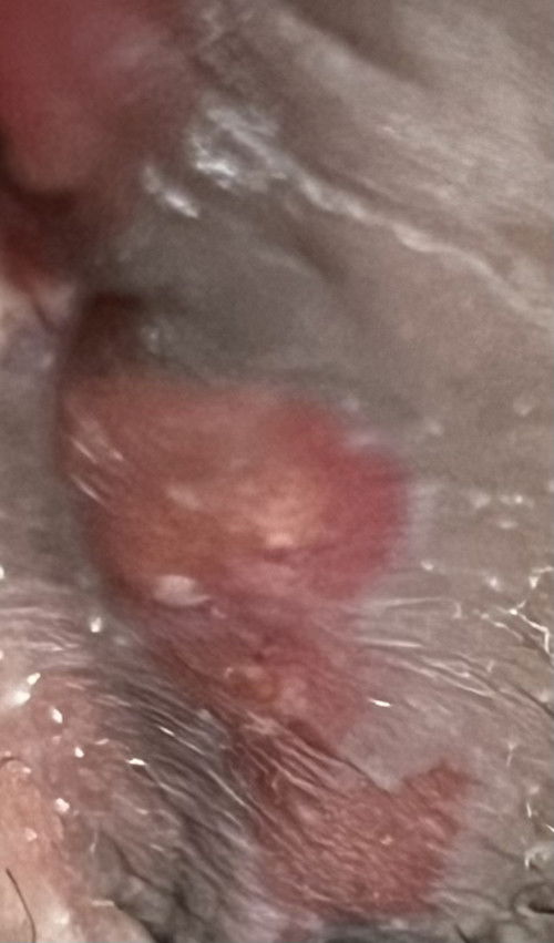 แผลฝีเย็บเป็นแบบนี้ปกติรึป่าวค่ะ