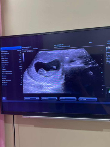 Usg baby 9 weeks