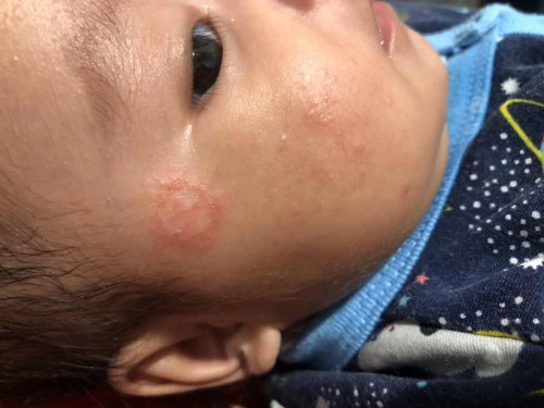Kurap bayi