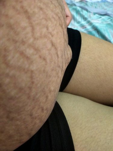 Hi mga mi. Anu po kaya itong bukol na hindi nawala after kong manganak. Cs po ako, 26days na
