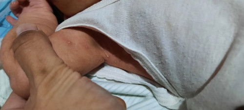 Bintik bernanah pada bayi NB