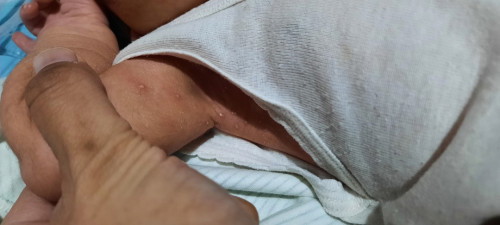 Bintik bernanah pada bayi NB