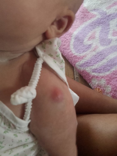 น้องมีตุ้มเเบบโดนอะไรกัดคะเเม่