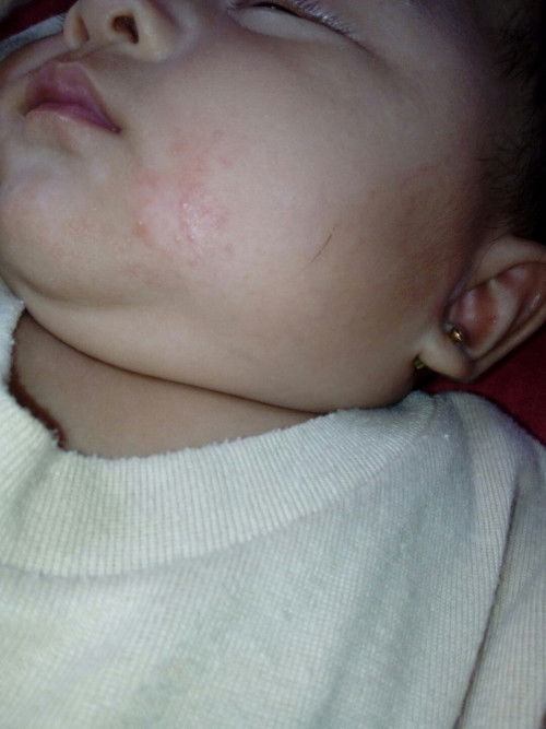 Ruam merah di pipi