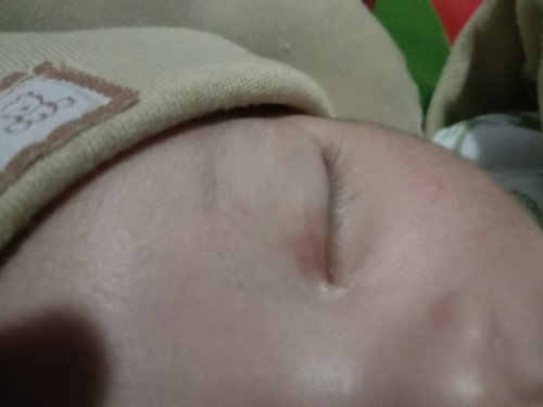 Kelopak mata bayi merah