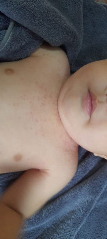 Gatal kemerahan pada baby